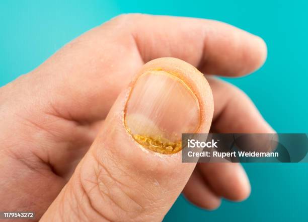 Fingernail Psoriasis Stock Photo - Download Image Now - Fingernail, Psoriasis, Illness