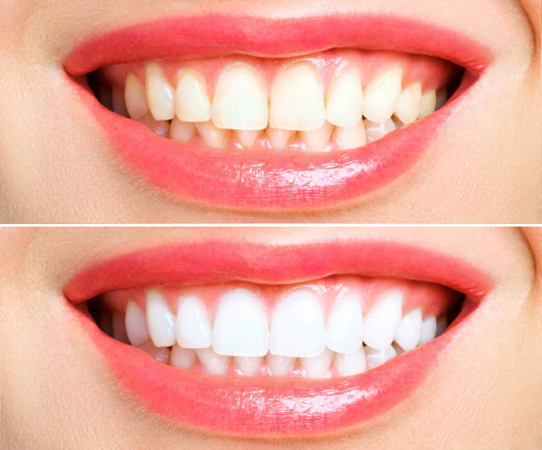 istock woman teeth before and after whitening. Over white background 1179583838
