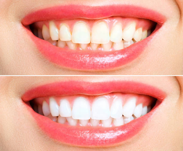 woman teeth before and after whitening. Over white background woman teeth before and after whitening. Over white background. Dental clinic patient. Image symbolizes oral care dentistry, stomatology. tooth whitening photos stock pictures, royalty-free photos & images