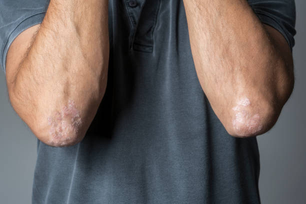 Man with psoriasis on his elbows Man with psoriasis on his elbows psoriasis stock pictures, royalty-free photos & images