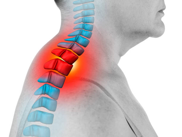 白い背景に分離された頸椎の頸部痛、坐骨神経痛および脊柱側弯症、カイロプラクター治療概念 - hump ストックフォトと画像