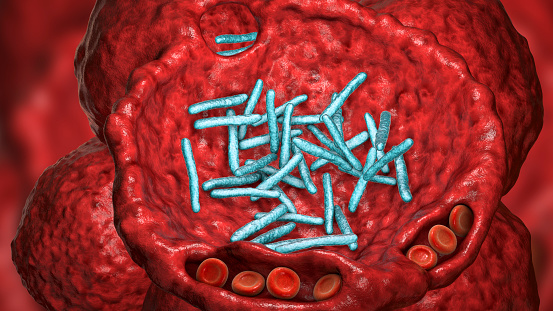 Bacterial pneumonia, medical concept. 3D illustration showing rod-shaped bacteria inside alveoli