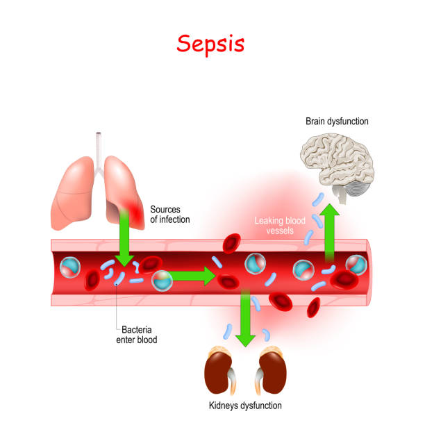 Sepsis. Close-up of cross section of blood vessel with Bacterial infection Sepsis. Close-up of cross section of blood vessel with Bacterial infection. septicaemia is a life-threatening illness. Effects of sepsis. Vector illustration endocarditis stock illustrations