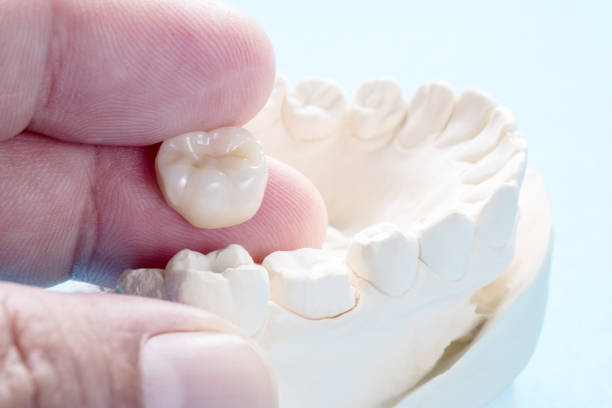 Prosthodontics or Prosthetic Closeup / Prosthodontics or Prosthetic / Crown and bridge equipment and model express fix restoration. dental crown stock pictures, royalty-free photos & images