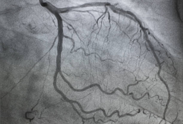 Left coronary angiography.Left coronary artery disease. stock photo