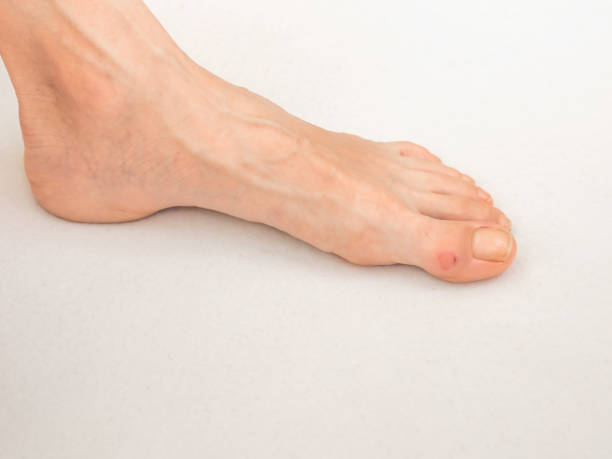 istock Close up of Calluses. Painful corn on foot. 1179749721