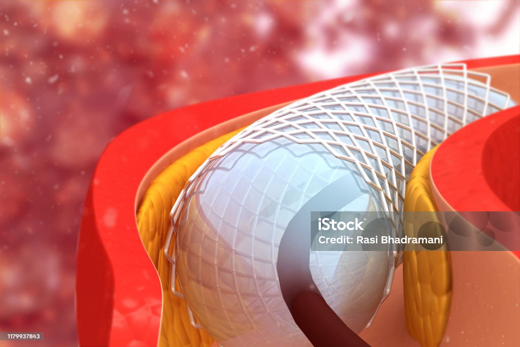 Angioplasty And Stent Placement Stock Photo - Download Image Now - Stent,  Angioplasty, Cardiologist - iStock