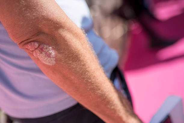 Close-up psoriasis Close-up psoriasis on man's elbow, Nikon Z7 photo psoriasis stock pictures, royalty-free photos & images