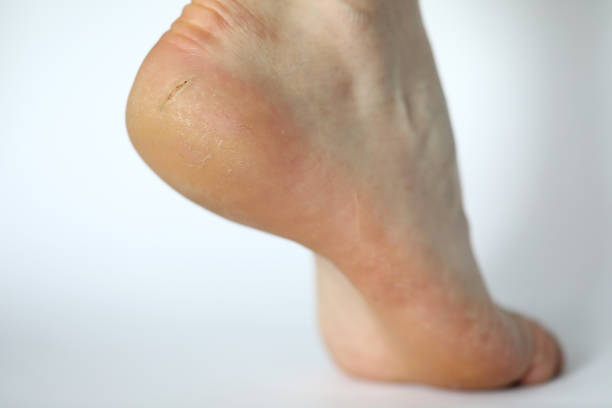istock Painful cracked skin on foot 1180159076