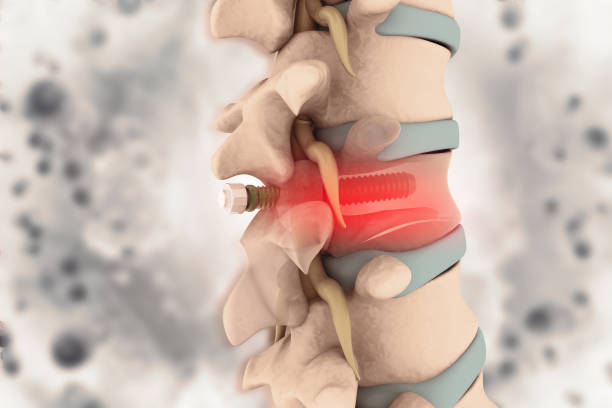 istock spinal column with implant, screw placement, 3d illustration 1180166415