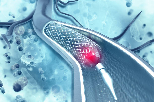 istock Stent angioplasty on scientific background 1180167142
