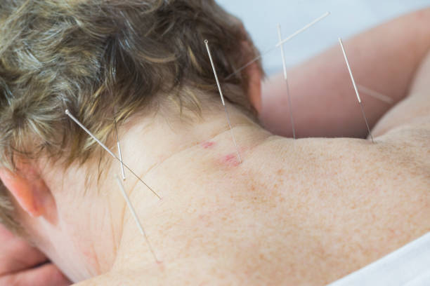 istock Elderly woman undergoing acupuncture procedure 1180411712
