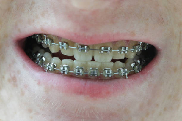 Image of the lower face of an unrecognisable caucasian, teenage boy focus on metal fixed braces on upper and lower teeth Stock photo showing the brackets of a metal fixed brace in the mouth of a caucasian, teenage boy. flared nostril photos stock pictures, royalty-free photos & images