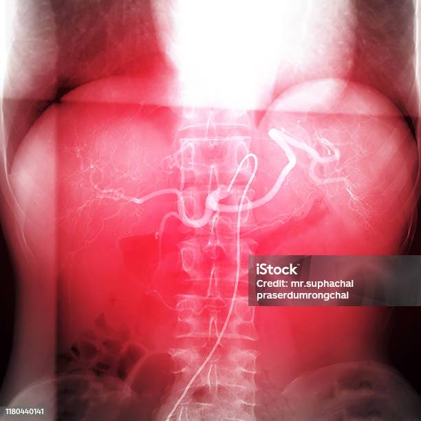 Xray Image Of Toce Stock Photo - Download Image Now - Cardiac Catheterization, Arteriogram, Ender