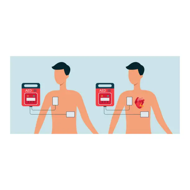 Vector illustration of Automated external defibrillator with human and man body, aed concept for heart.