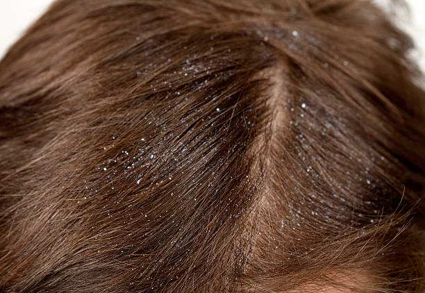 Dandruff Close up of dandruff dandruff stock pictures, royalty-free photos & images