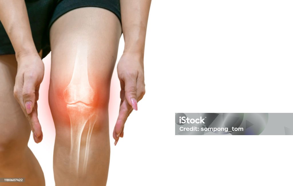 Mänskliga Artros Inflammation Ben Leder-foton och bilder på Knä - Knä, Fysisk skada, Ligament - iStock