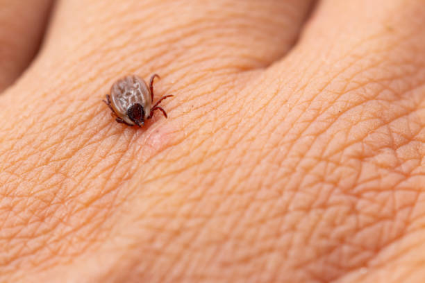istock Tick filled with blood sitting on human skin. 1180612795