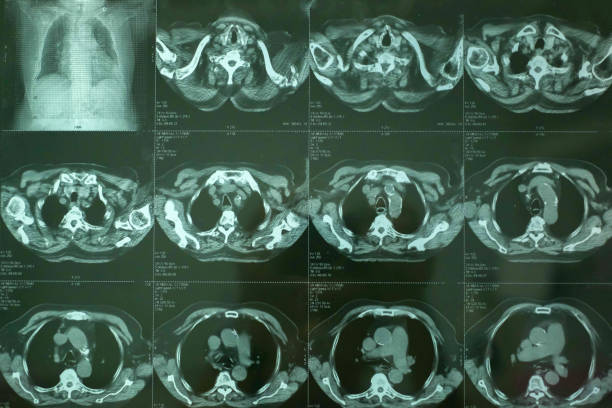 tomografía computarizada del tórax, immage de rayos x. - cat scan abdomen medical scan x ray fotografías e imágenes de stock