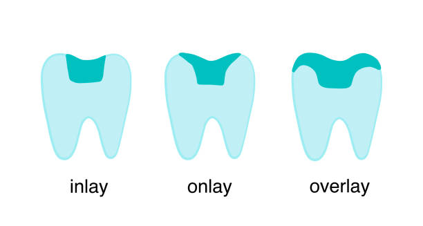 illustrazioni stock, clip art, cartoni animati e icone di tendenza di intarsio sovrapposizione dente corona denti restauro porcellana disegnata a mano illustrazione vettoriale tipo classificazione - inlaid