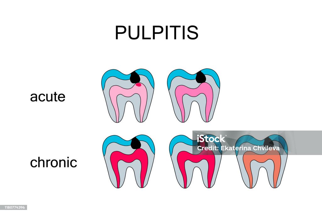 Pulpitis Skin Types Of Pulpitis Hand Drawn Vector Illustration In Cartoon Comic Style ...