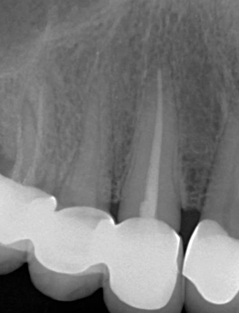 X-ray image close-up of tooth root treatment stock photo