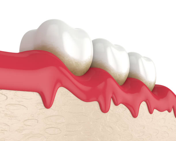 3d render of teeth in bleeding gums stock photo