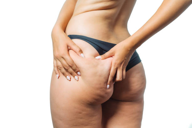 girl shows holding and pushing the skin of the legs cellulite, orange peel. treatment and disposal of excess weight, the deposition of subcutaneous fat tissue - women human leg body buttocks imagens e fotografias de stock