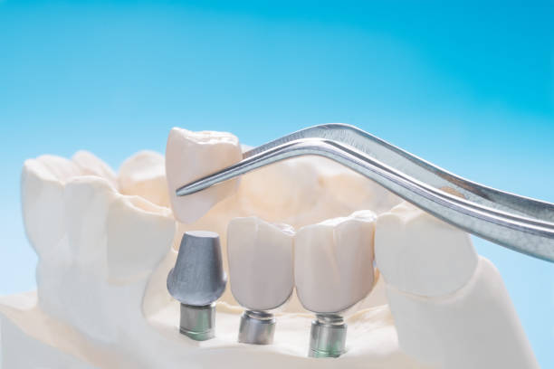 istock Close up implant and prosthodontic model. 1180903254