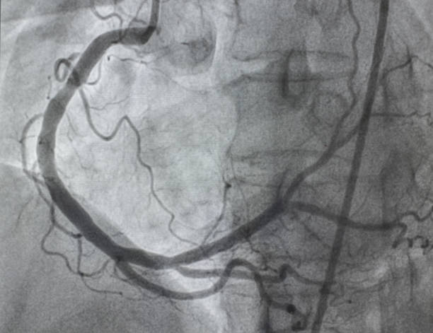 koronare angiographie. - human heart heart attack x ray image chest stock-fotos und bilder