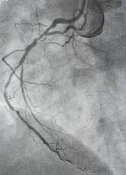 koronare angiographie. - human heart heart attack x ray image chest stock-fotos und bilder