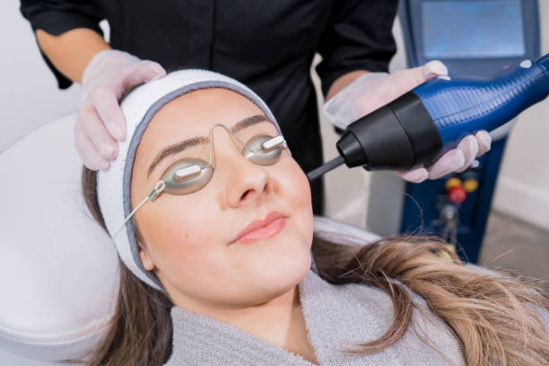 CO2 fractional ablative laser being used for skin rejuvenation (skin resurfacing) as a medical cosmetic procedure in a beauty laser clinic. Female patient wearing goggles, with beauty laser technician CO2 fractional ablative laser being used for skin rejuvenation (skin resurfacing) as a medical cosmetic procedure in a beauty laser clinic. Female patient wearing goggles, with beauty laser technician medical laser photos stock pictures, royalty-free photos & images