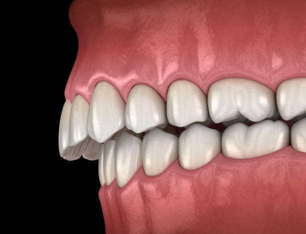 overbite zahnverschluss ( maloklusion der zähne ). medizinisch genaue zahn-3d-illustration - fehlbiss stock-fotos und bilder