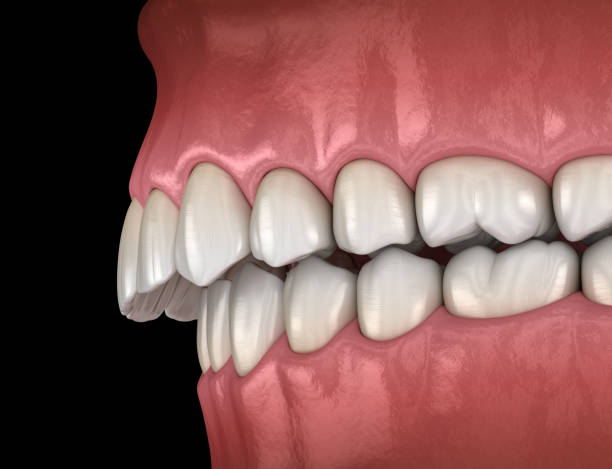 istock Overbite dental occlusion ( Malocclusion of teeth ). Medically accurate tooth 3D illustration 1181143478