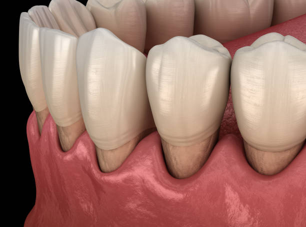 istock Gum recession process. Medically accurate 3D illustration 1181143516