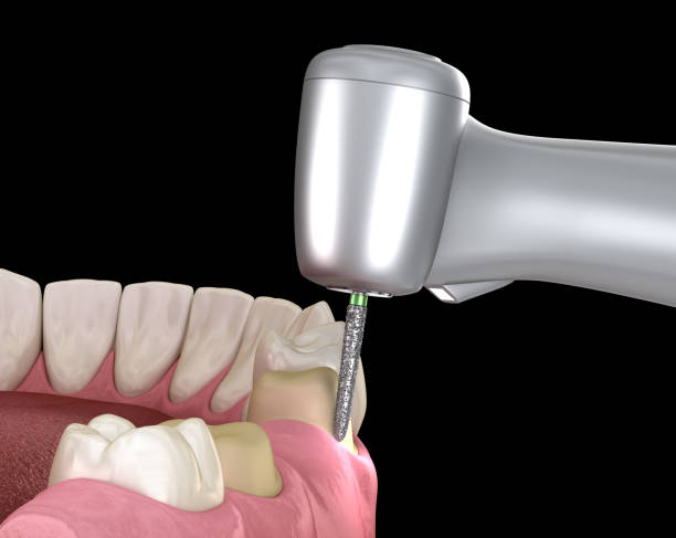 istock Premolar preparation process for dental crown placement. Medically accurate 3D illustration 1181143630