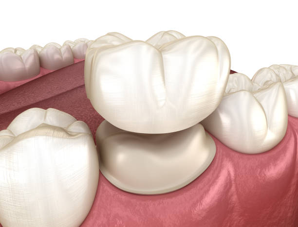 istock Preparated molar tooth for dental crown placement. Medically accurate 3D illustration 1181143744