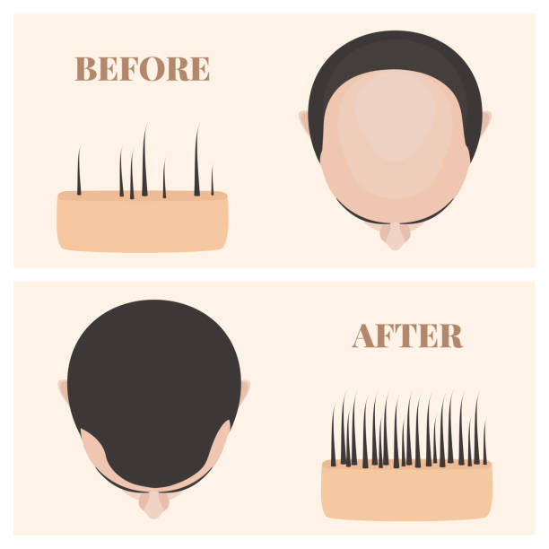 ilustrações, clipart, desenhos animados e ícones de homem na vista superior antes e depois do tratamento da perda de cabelo - alopecia homem
