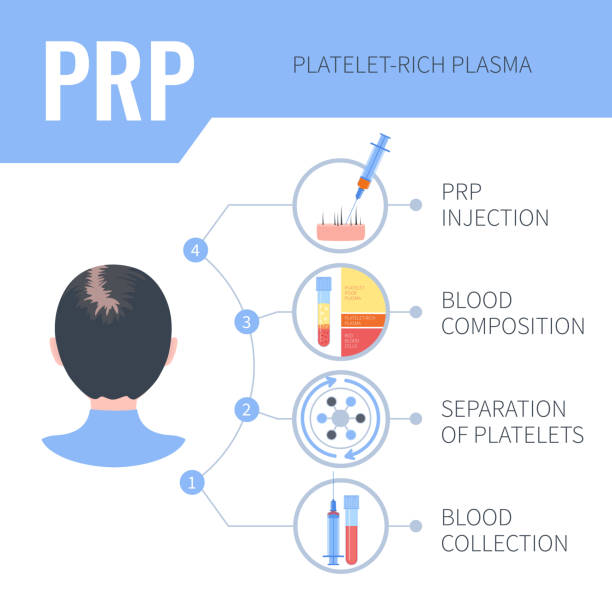 prp haar-nachwuchs-therapie infografiken für frauen - operation grafiken stock-grafiken, -clipart, -cartoons und -symbole