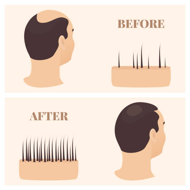 Man In Side View Before And After Hair Loss Treatment Stock Illustration -  Download Image Now - iStock