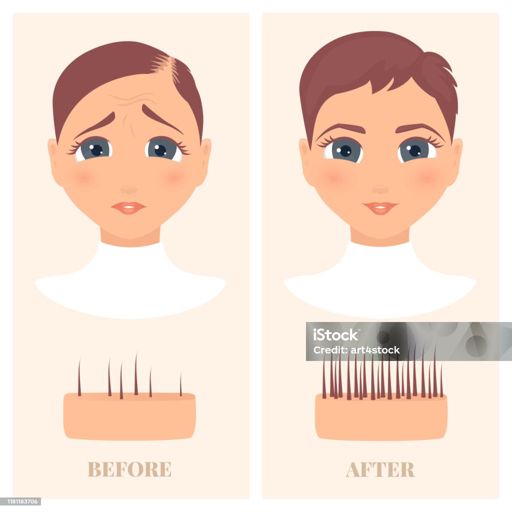 Woman Before And After Hair Loss Treatment In Front View Stock Illustration  - Download Image Now - iStock