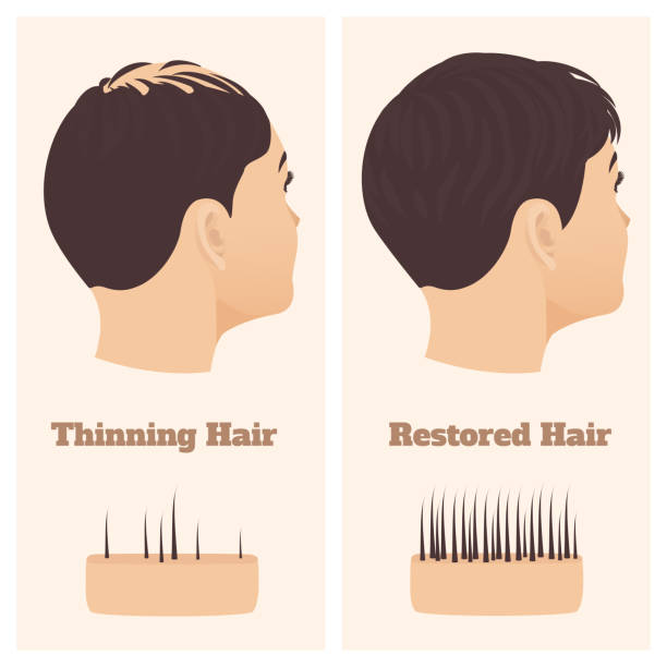 Woman In Side View Before And After Hair Loss Treatment Stock Illustration  - Download Image Now - iStock
