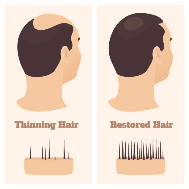 ilustrações, clipart, desenhos animados e ícones de homem na vista lateral antes e depois do tratamento da perda de cabelo - alopecia homem