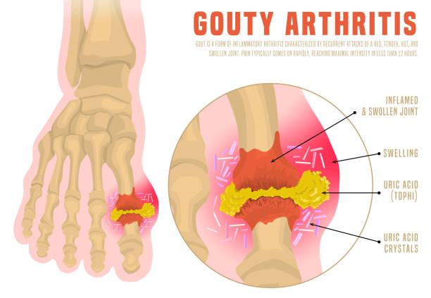 illustrations, cliparts, dessins animés et icônes de infographie sur l'arthrite de goutte - big toe