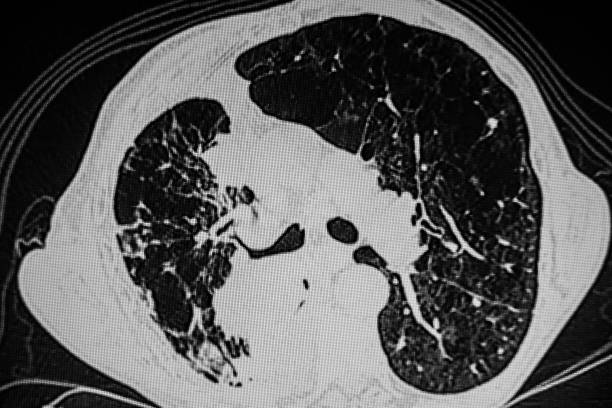 istock CAT -Scan: emphysema  and lung tumor 1181227536