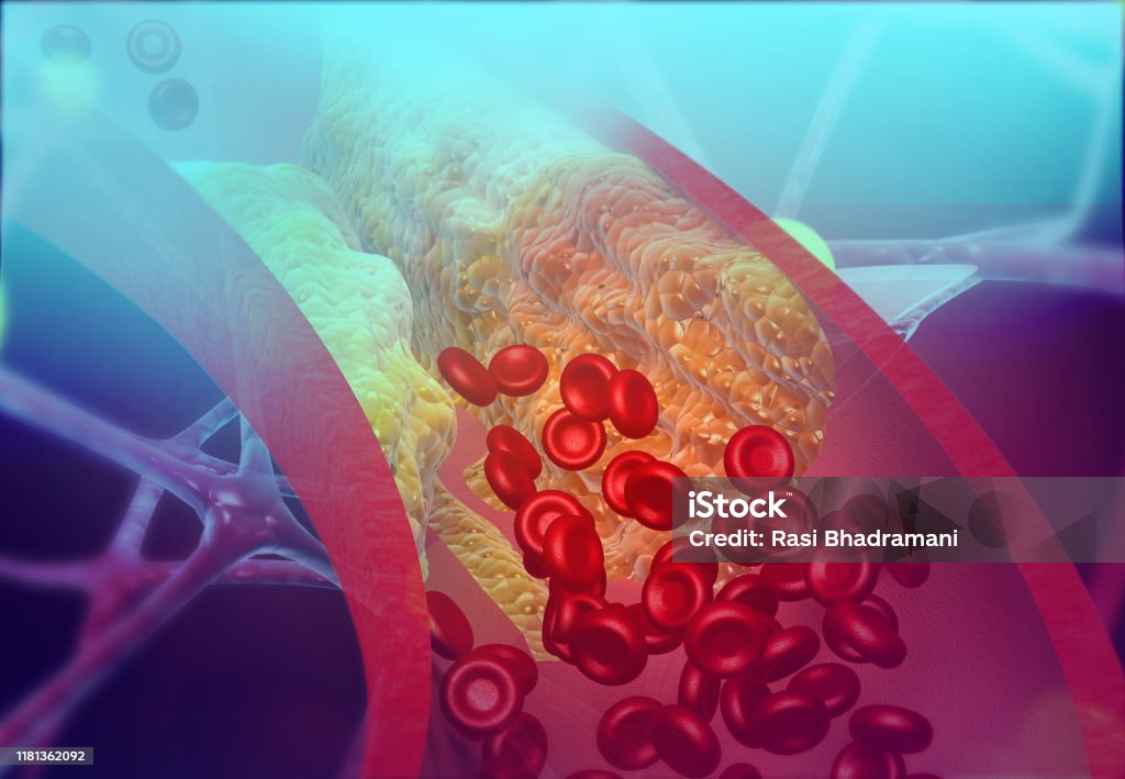 Cholesterol blocking artery Cholesterol blocking artery. 3d illustration Cholesterol Stock Photo
