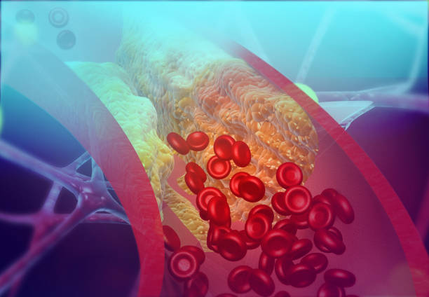 Cholesterol blocking artery Cholesterol blocking artery. 3d illustration vein stock pictures, royalty-free photos & images