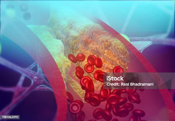 Cholesterol Blocking Artery Stock Photo - Download Image Now - Cholesterol, Heart - Internal Organ, Blood Vessel