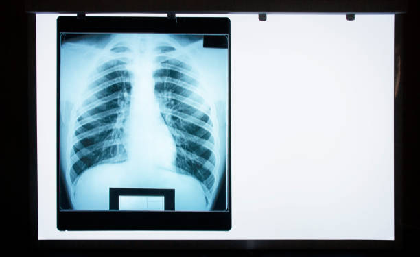 normalny wykres rentgenowski płuc na negatoskopie - x ray chest human lung rib cage zdjęcia i obrazy z banku zdjęć