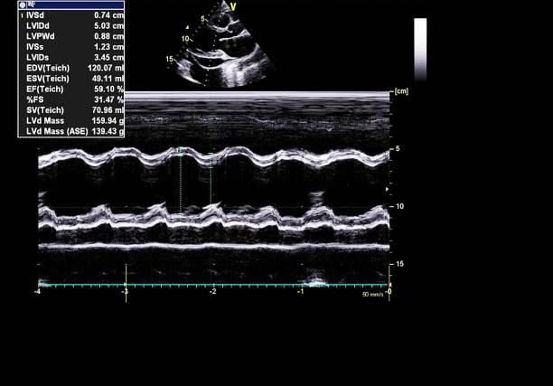 istock Screen of echocardiography (ultrasound) machine. 1181639492